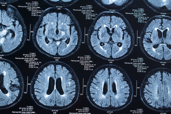 "Энцефалография покажет" - после визита омбудсмена у Дадина поищут эпилепсию